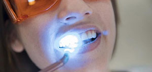 صورة: حساسية الأسنان و تهيج اللثة و عدم الحصول على النتيجة المرغوبة