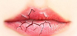 صورة: تشقق الشفاه و أسباب تشقق الشفاه و وصفات لعلاج تشقق الشفاه