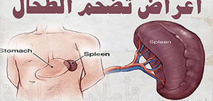 صورة: الطحال و ما هي أمراض الطحال و تشخيص أمراض الطحال