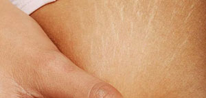 صورة: المرأة الحامل و تشققات الحمل و كيفية المحافظة على الجسم من التشققات