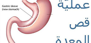 صورة: قص المعدة و المضاعفات المحتملة بعد العملية